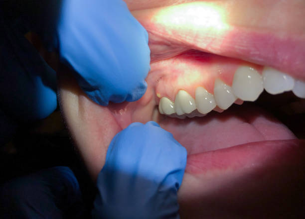 Best Urgent Tooth Repair  in Sam Rayburn, TX